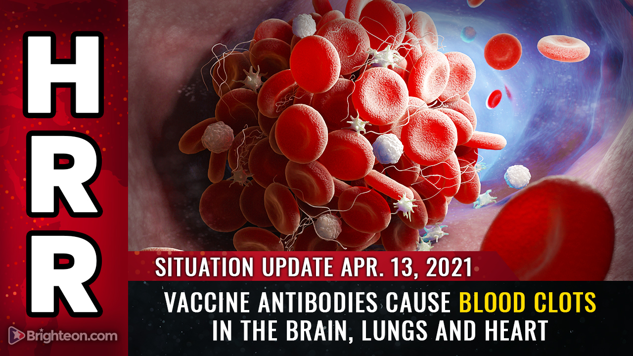 Situation Update, April 13th, 2021 - Vaccine antibodies CAUSE blood clots in the brain, lungs and heart